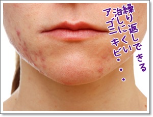Adolescent girl suffering in acne